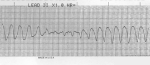 Torsades de Pointes.png